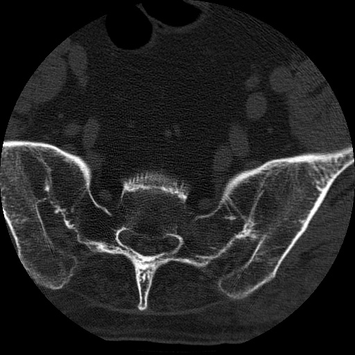 Ankylosing spondylitis complicated by fracture-dislocation (Radiopaedia 33583-34674 Axial non-contrast 169).jpg