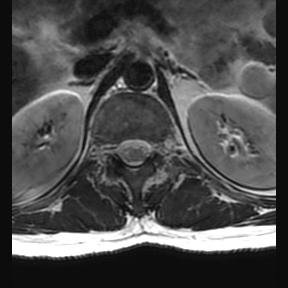 File:Ankylosing spondylitis with zygapophyseal arthritis (Radiopaedia 38433-40516 Axial T2 23).jpg