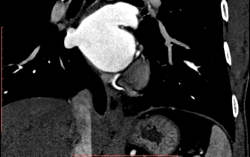 Anomalous left coronary artery from the pulmonary artery (ALCAPA) (Radiopaedia 70148-80181 B 216).jpg