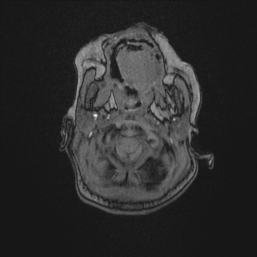 Anoxic brain injury (Radiopaedia 79165-92139 Axial MRA 14).jpg