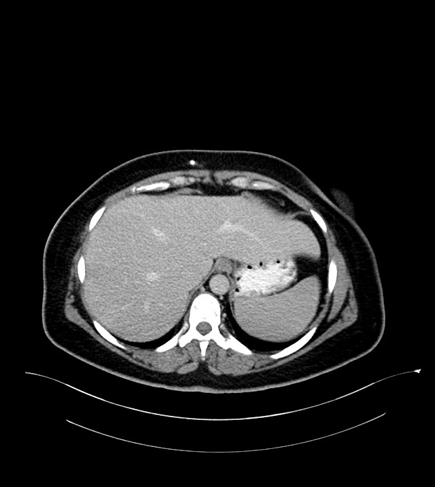 Anterior abdominal wall CSF pseudocyst (CSFoma) (Radiopaedia 79453-92571 A 19).jpg