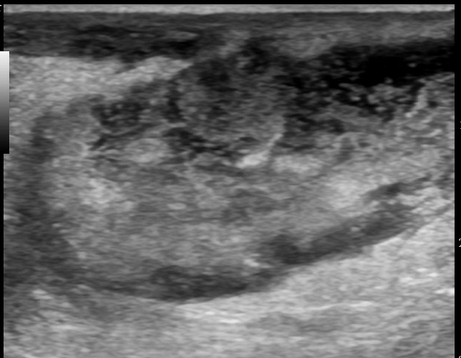 File:Anterior abdominal wall abscess (Radiopaedia 17732-17480 B 1).jpg