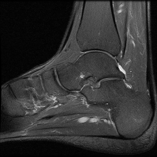 File:Anterior calcaneal process fracture (Radiopaedia 74654-85611 Sagittal PD fat sat 9).jpg