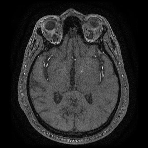 Anterior cerebral artery infarction (Radiopaedia 46794-51323 Axial MRA 103).jpg