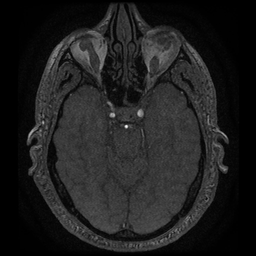Anterior cerebral artery infarction (Radiopaedia 46794-51323 Axial MRA 57).jpg