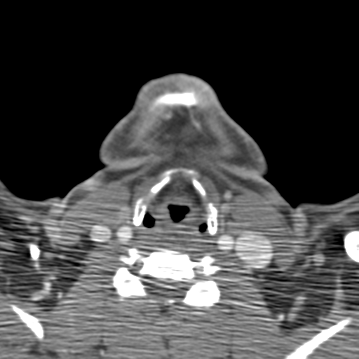 Anterior cerebral artery territory infarct (Radiopaedia 39327-41581 B 82).png