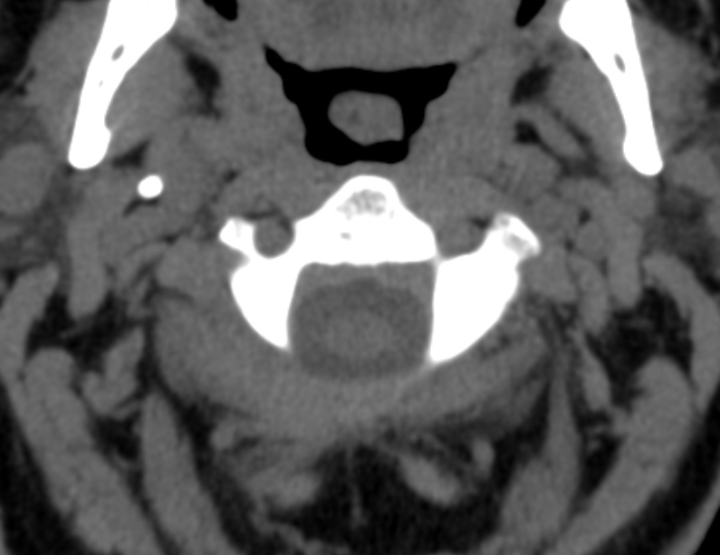 Anterior cervical postdiscectomy arthrodesis (Radiopaedia 32678-33646 Axial non-contrast 20).jpg