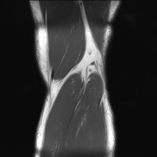 File:Anterior cruciate ligament full thickness tear (Radiopaedia 66268-75467 Coronal T1 21).jpg