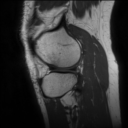 Anterior cruciate ligament rupture and posteromedial corner injury (Radiopaedia 67338-76723 Sagittal PD 130).jpg