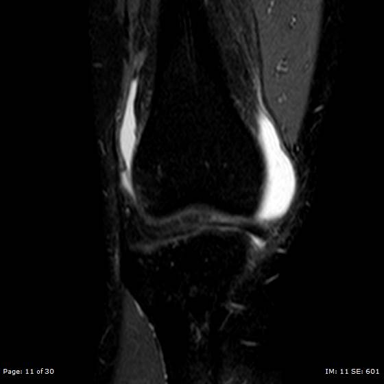File:Anterior cruciate ligament tear (Radiopaedia 70783-80964 Coronal STIR 11).jpg
