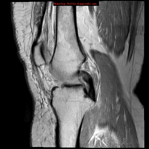 File:Anterior cruciate ligament tear - complete (Radiopaedia 12175-12514 Sagittal PD 12).jpg