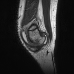 File:Anterior cruciate ligament tear - pediatric (Radiopaedia 62152-70260 Sagittal PD 27).jpg