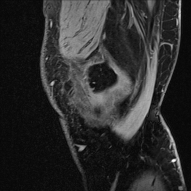 Anterior cruciate ligament tear - ramp lesion (Radiopaedia 71883-82322 Sagittal T1 vibe 126).jpg