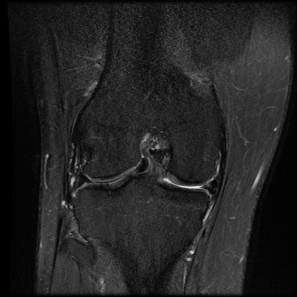 File:Anterior cruciate ligament tear with posteromedial corner injury, bucket-handle meniscal tear and chondral delamination (Radiopaedia 75501-86744 Coronal PD fat sat 16).jpg