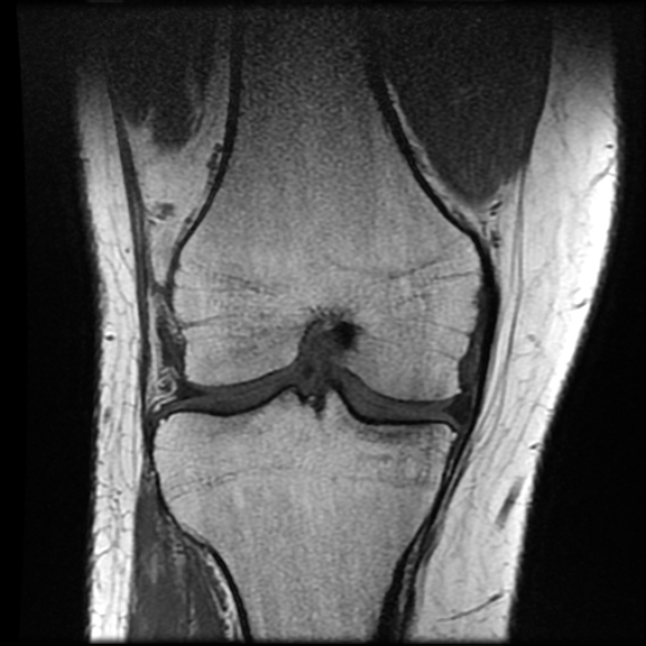 File:Anterior cruciate ligament tear with posteromedial corner injury, bucket-handle meniscal tear and chondral delamination (Radiopaedia 75501-86744 Coronal T1 14).jpg