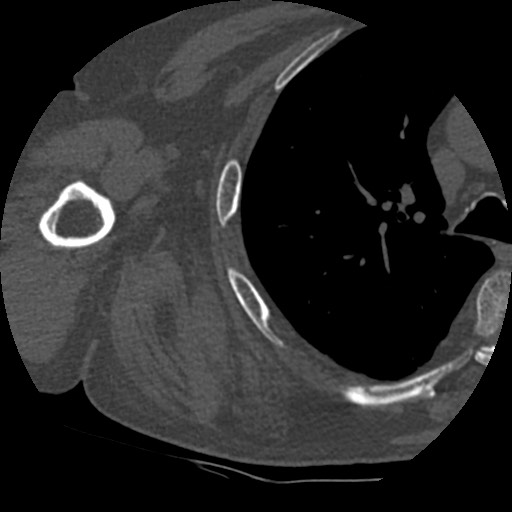 Anterior glenohumeral dislocation with Hill-Sachs lesion (Radiopaedia 62877-71249 Axial bone window 77).jpg