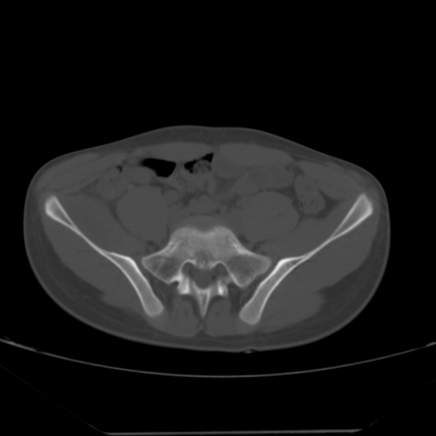 Anterior inferior iliac spine avulsion fracture (Radiopaedia 49469-54627 Axial bone window 8).jpg