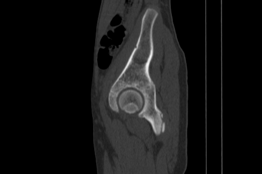 Anterior inferior iliac spine avulsion injury (Radiopaedia 88666-105376 Sagittal bone window 72).jpg