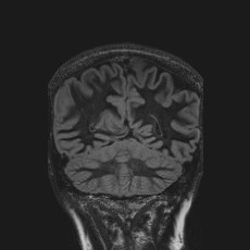 Anterior temporal encephalocele (Radiopaedia 82624-96808 Coronal FLAIR 39).jpg