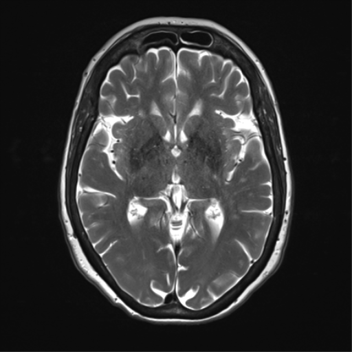 File:Anterior temporal pole cysts (Radiopaedia 46629-51102 C 19).png