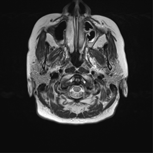 File:Anterior temporal pole cysts (Radiopaedia 46629-51102 C 2).png