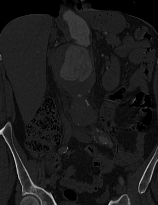 File:Anterior vertebral scalloping (abdominal aortic aneurysm) (Radiopaedia 66744-76067 Coronal bone window 19).jpg