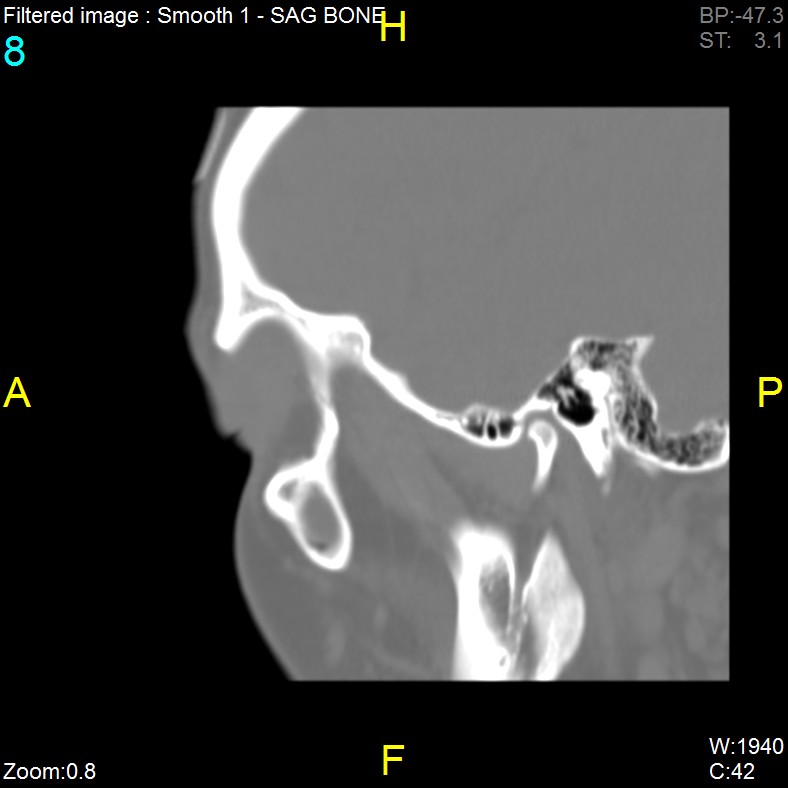 Antrochoanal polyp (Radiopaedia 65101-74094 Sagittal bone window 8).jpg