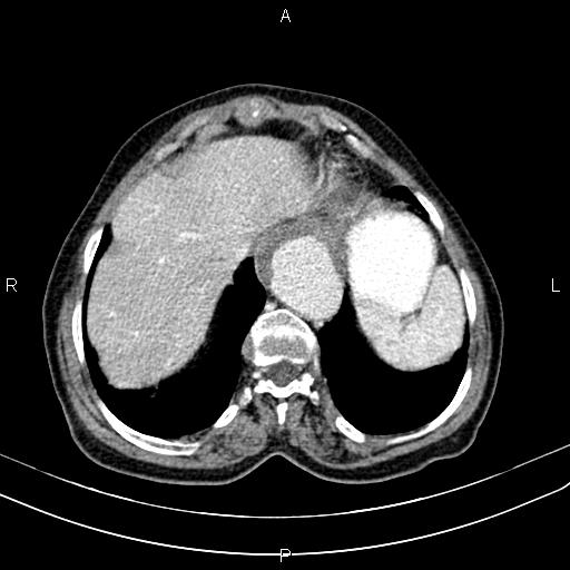 File:Aortic aneurysm and Lemmel syndrome (Radiopaedia 86499-102554 A 14).jpg