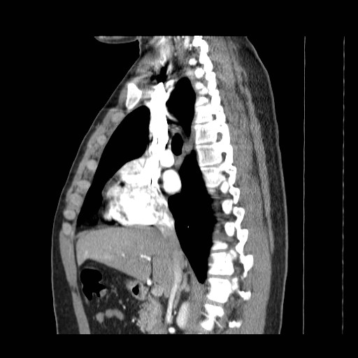 File:Aortic arch stent (Radiopaedia 30030-30595 E 1).jpg