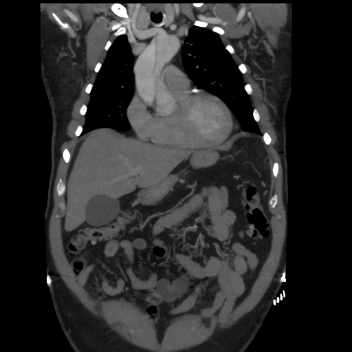 File:Aortic dissection- Stanford A (Radiopaedia 37759-39664 Coronal C+ delayed 12).png