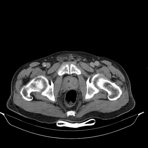 File:Aortic dissection- Stanford type A (Radiopaedia 22085-22085 Axial C+ delayed 53).jpg