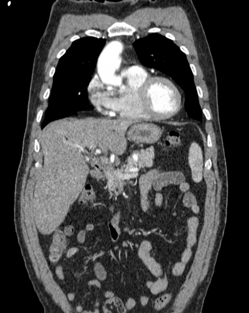 Aortic dissection (Radiopaedia 44411-48061 A 4).jpg
