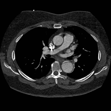 File:Aortic dissection (Radiopaedia 57969-64959 A 148).jpg