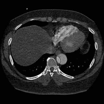 File:Aortic dissection (Radiopaedia 57969-64959 A 230).jpg