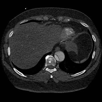 Aortic dissection (Radiopaedia 57969-64959 A 247).jpg