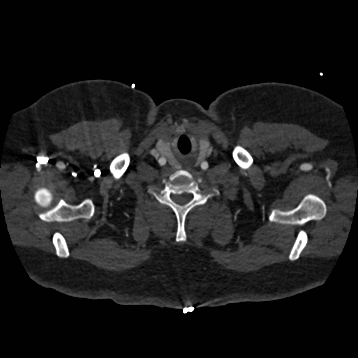 Aortic dissection (Radiopaedia 57969-64959 A 7).jpg