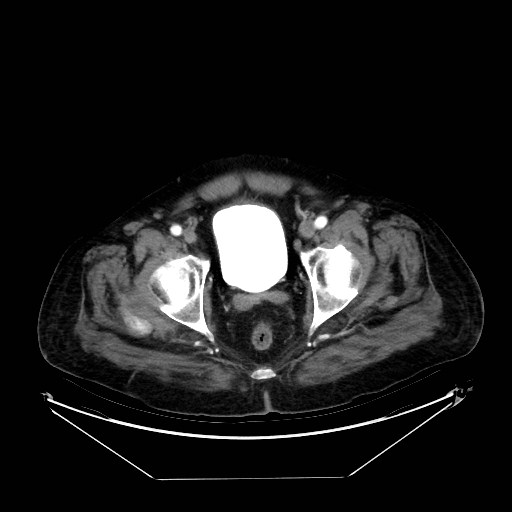 Aortic dissection (Radiopaedia 62562-71000 A 105).jpg