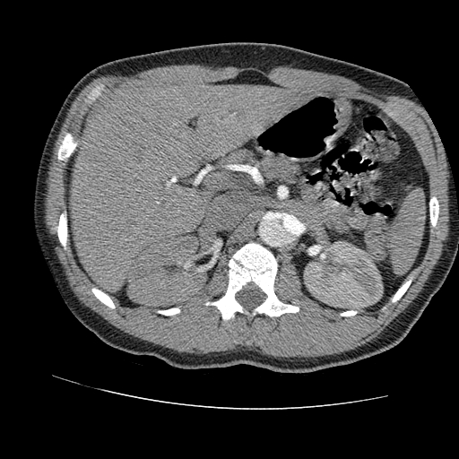 File:Aortic dissection - Stanford A -DeBakey I (Radiopaedia 28339-28587 B 117).jpg