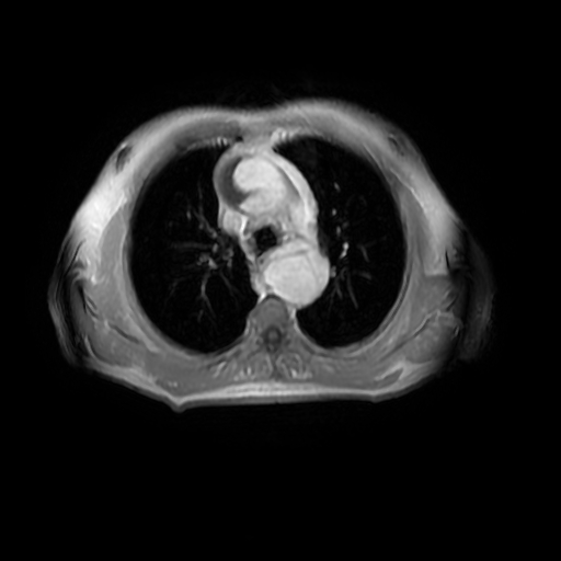 Aortic dissection - Stanford A - DeBakey I (Radiopaedia 23469-23551 Axial MRA 12).jpg