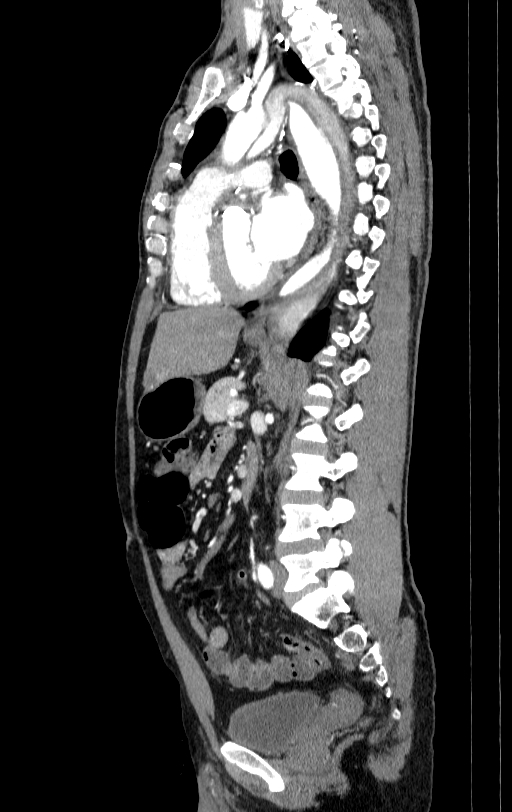 Aortic dissection - Stanford type A (Radiopaedia 83418-98500 B 44).jpg
