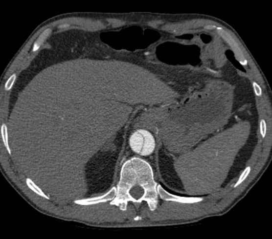Aortic dissection - Stanford type B (Radiopaedia 73648-84437 A 108).jpg