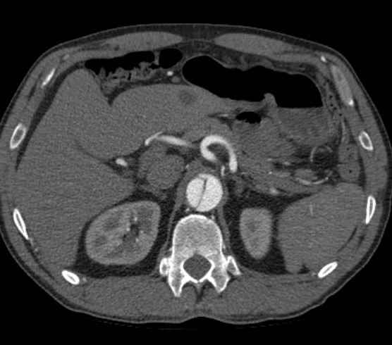 Aortic dissection - Stanford type B (Radiopaedia 73648-84437 A 125).jpg