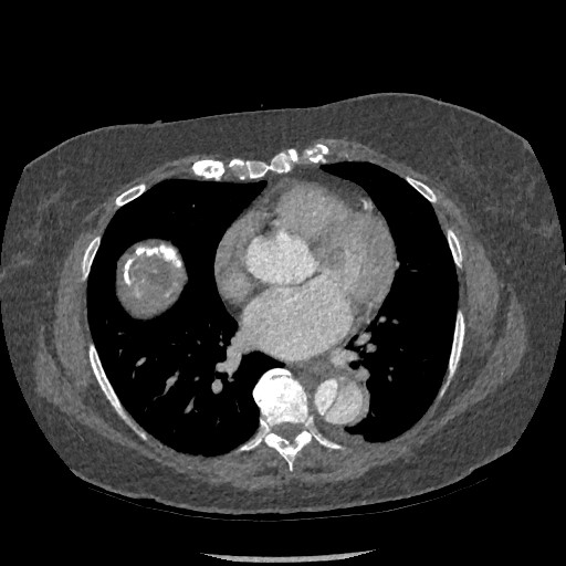 File:Aortic dissection - Stanford type B (Radiopaedia 88281-104910 A 52).jpg