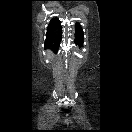 File:Aortic dissection - Stanford type B (Radiopaedia 88281-104910 B 80).jpg