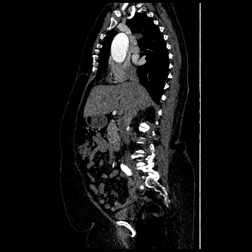 File:Aortic dissection - Stanford type B (Radiopaedia 88281-104910 C 31).jpg