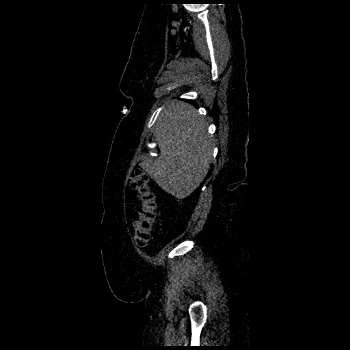 File:Aortic dissection - Stanford type B (Radiopaedia 88281-104910 C 7).jpg