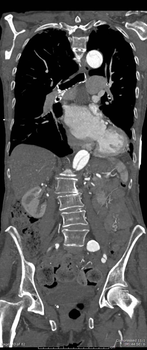 Aortic dissection with extension into aortic arch branches (Radiopaedia 64402-73204 A 43).jpg
