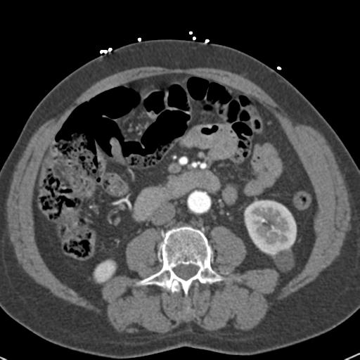 Aortic intramural hematoma (Radiopaedia 31139-31838 B 109).jpg
