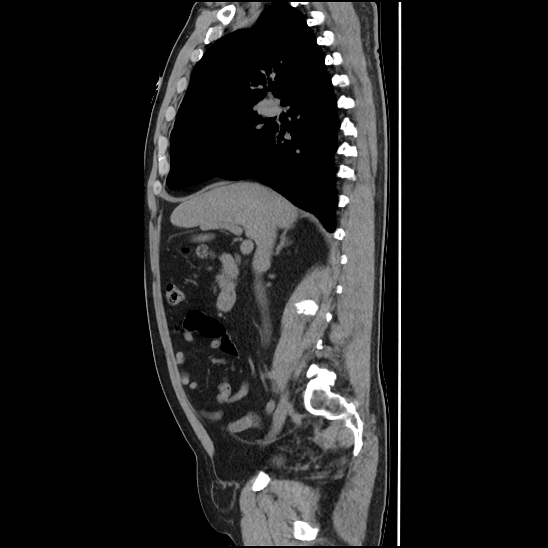 Aortic intramural hematoma (type B) (Radiopaedia 79323-92387 G 17).jpg