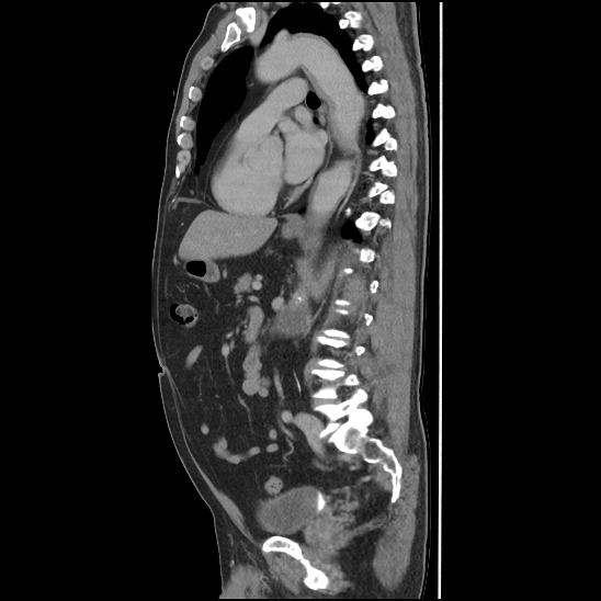 Aortic intramural hematoma (type B) (Radiopaedia 79323-92387 Sagittal C+ delayed 30).jpg